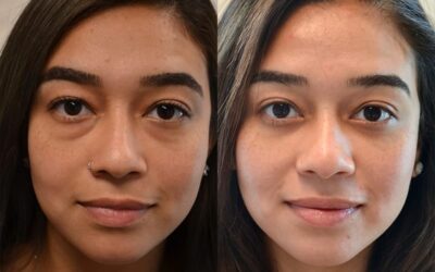 A Brief Overview of Eyelid Surgery & Types of Eyelid Surgery