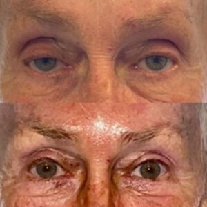 generous blepharoplasty IMG