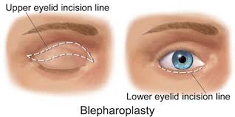 blog Difference Between Eyelid Surgery and Blepharoplasty img
