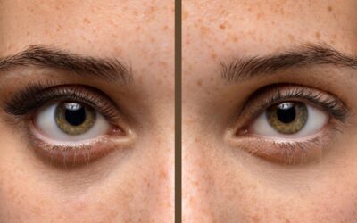 Droopy Eyelids: When Should You Consider Eyelid Surgery?